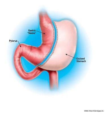 Sleeve Gastrectomy | Bariatric Surgery